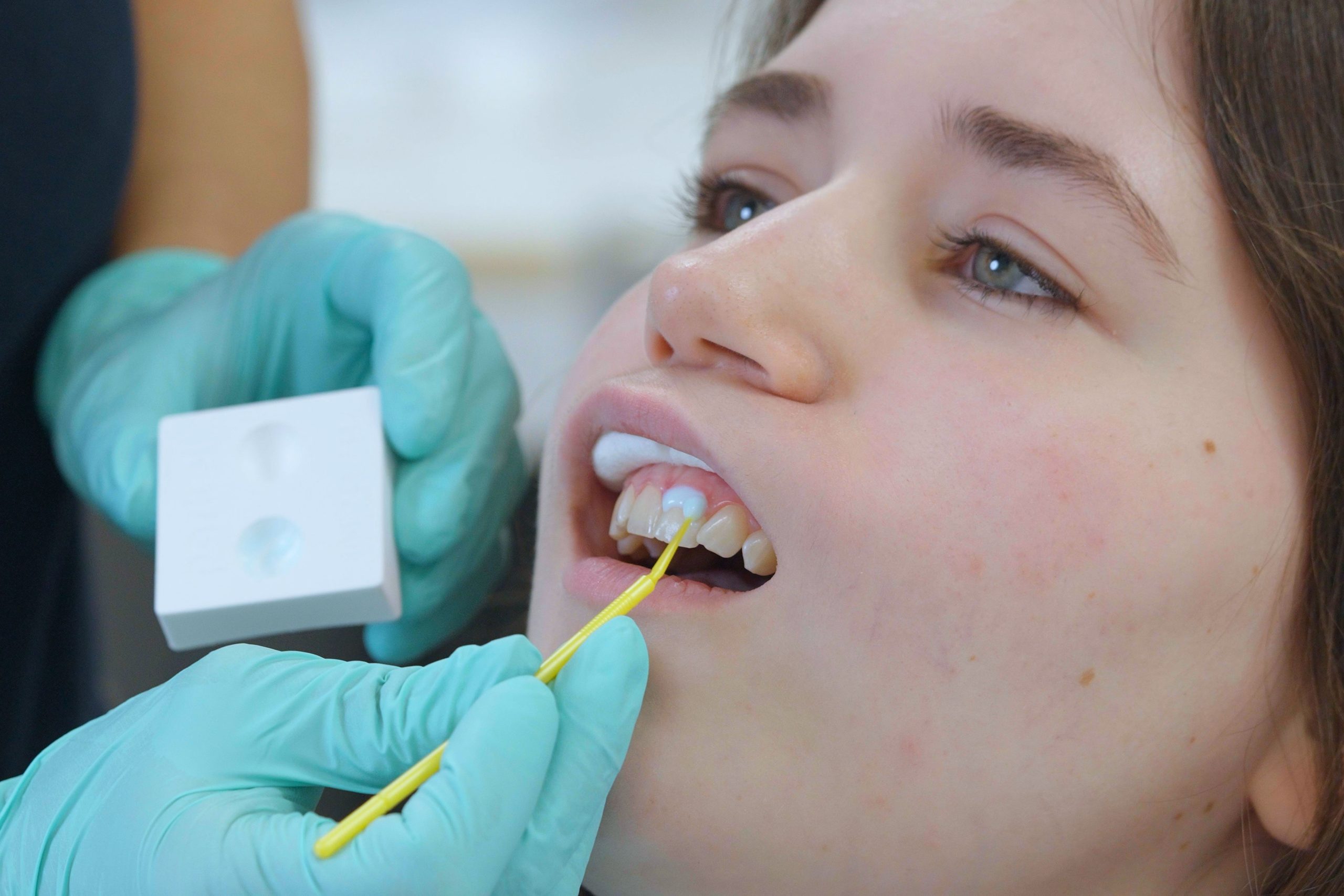 Predicta Bioactive Desensitizer, a desensitizing gel for teeth, being applied to a patient’s tooth using a microbrush