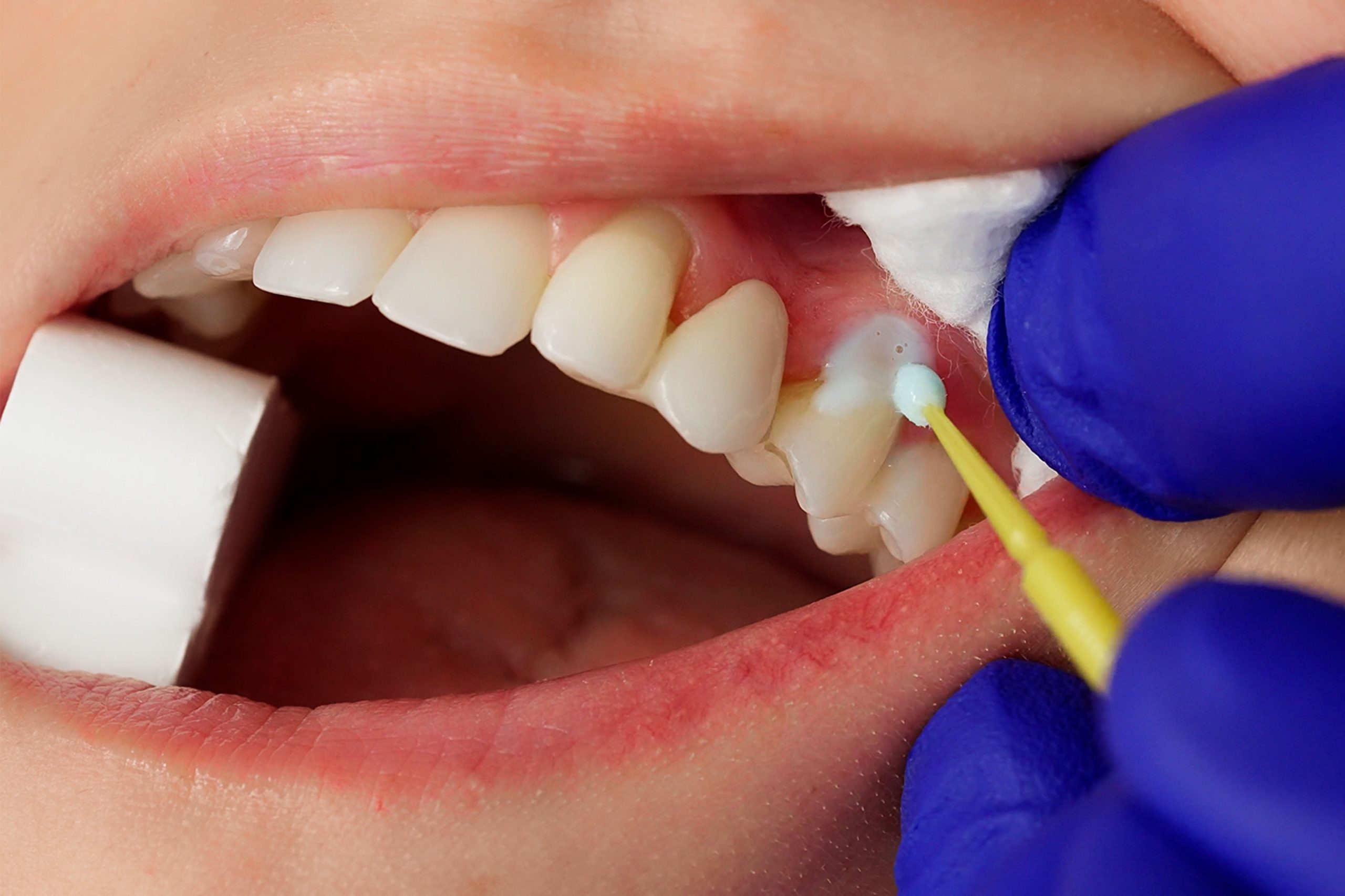 Predicta Bioactive Desensitizer, a desensitizing gel for teeth, being applied to a patient’s tooth using a microbrush