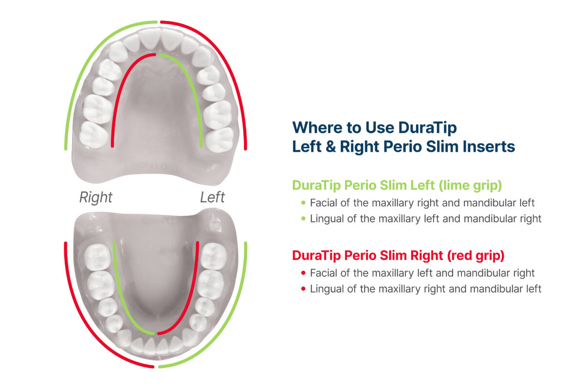 Where to use DuraTip perio left & right insert with a diagram