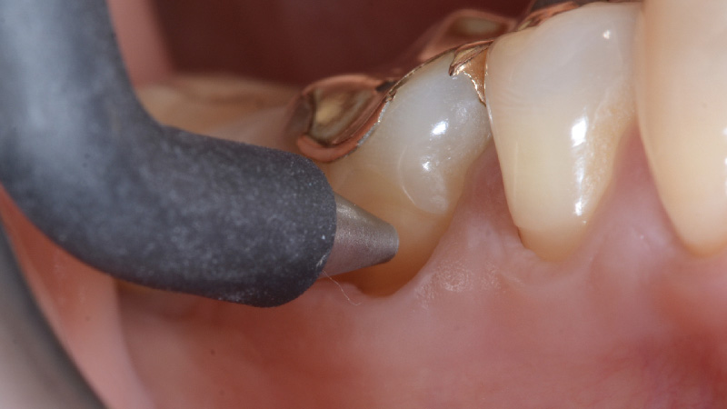 Digitest 3's autoclavable probe